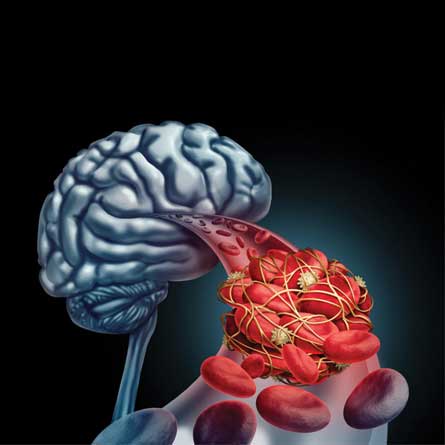 Acute stroke specialist in Delhi